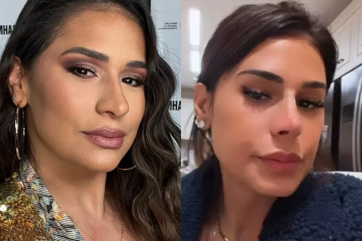 Simone "amarra" fios no nariz em novo procedimento; médico explica técnica