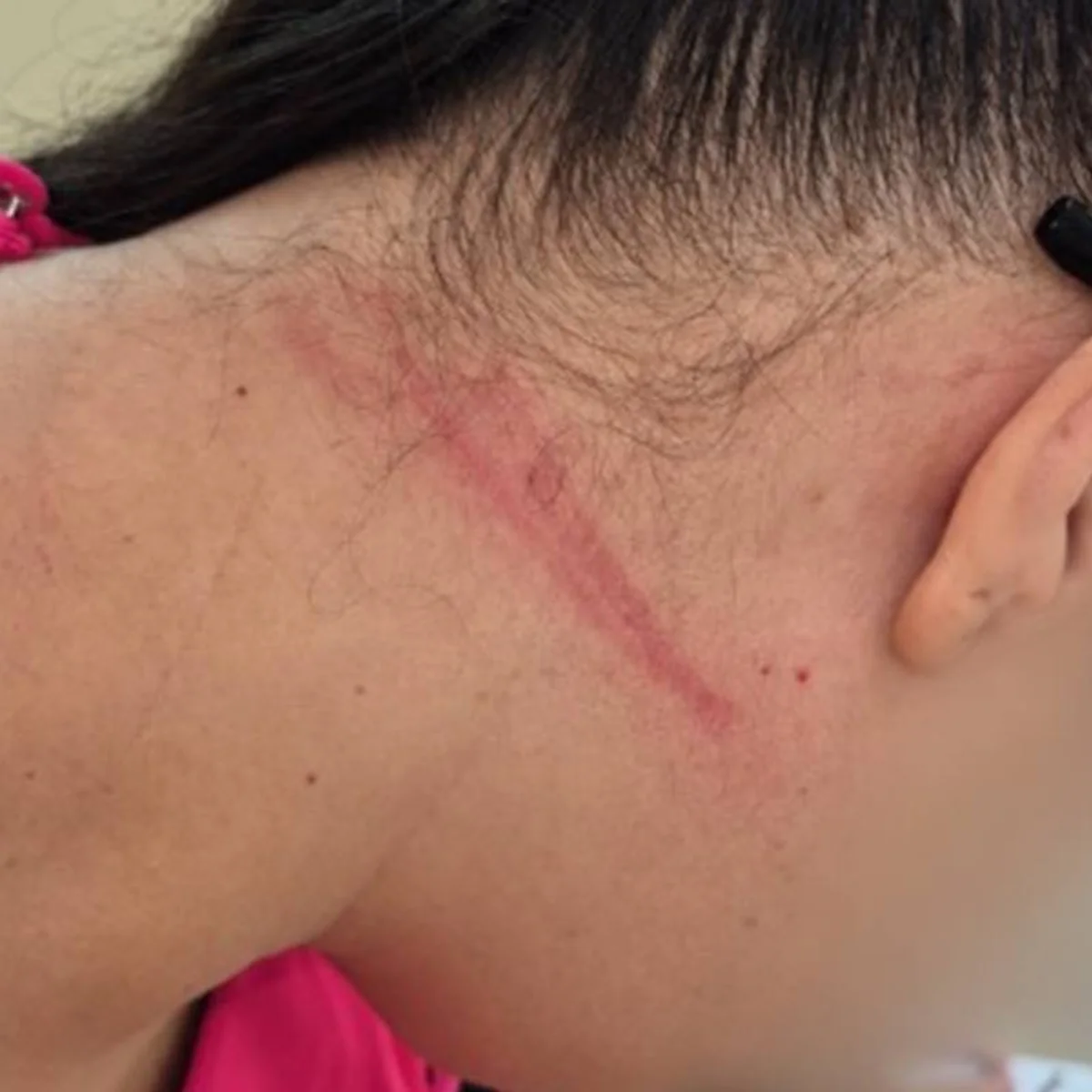 Fotos: técnica de enfermagem enforcada em UPA teve hematomas no pescoço
